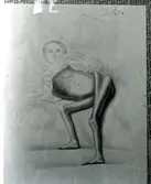 Västerås.
Teckning utförd av läkare.