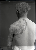 En man med utslag, sår, på rygg och arm, fotograferad bakifrån. Beställare: Dr Krikotz.